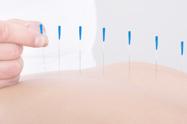 Dry Needling